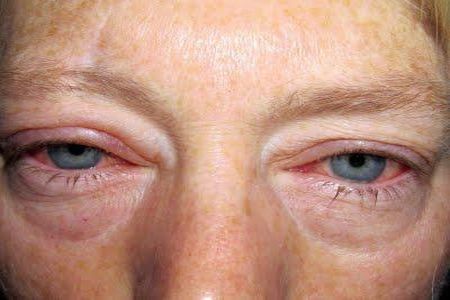 глаза от конъюнктивита