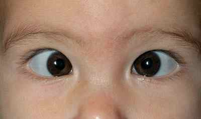 детское сходящееся косоглазие