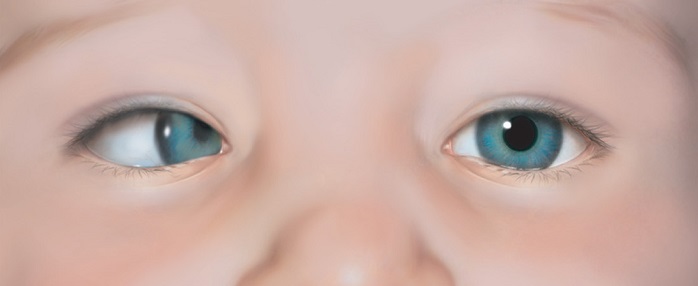 тип косых глаз