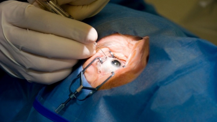 операция при дальнозоркости