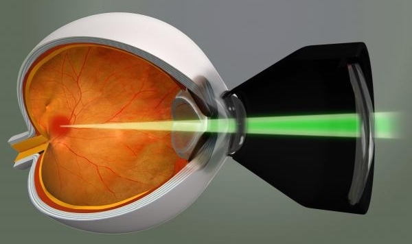 лечение диабетической ретинопатии