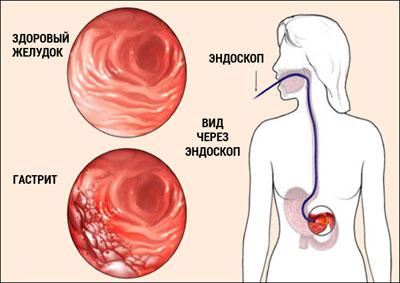 Проявление гастрита
