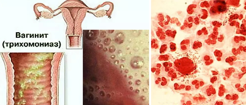 lechenie-trihomoniaza-u-zhenshhin.jpg