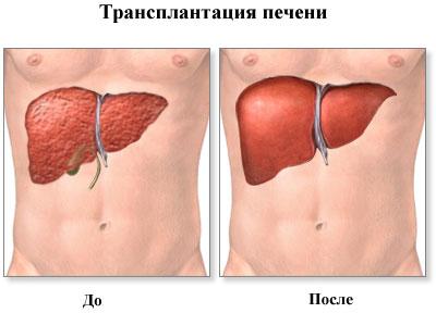 Пересадка печени