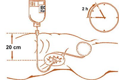 Форсированный диурез