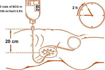 Процедура форсированного диуреза