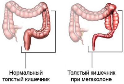 Кишечник при мегаколоне