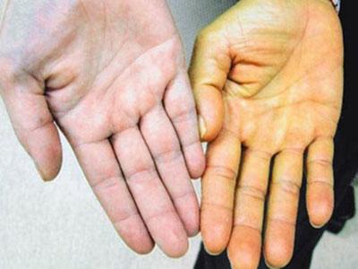 Цвет кожи при желтухе