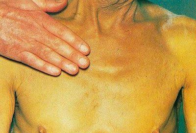Цвет кожи при желтухе