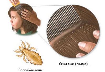 Проявление педикулеза