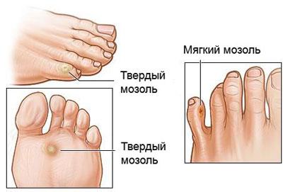 Виды мозолей