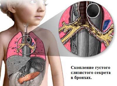 Симптомы муковисцидоза
