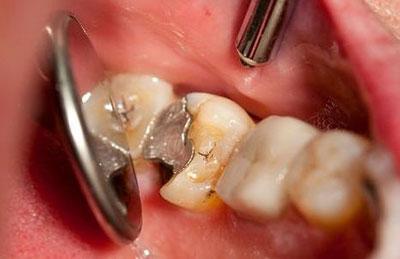 Мышьяк в зубе