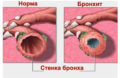 Проявление бронхита