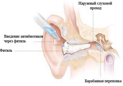 Воспаление уха при отите