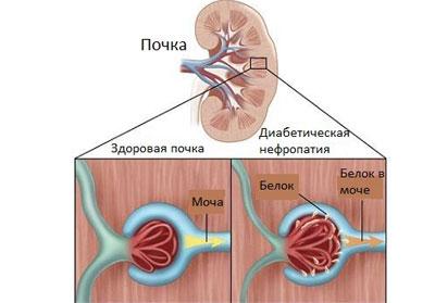 Нефропатия почек