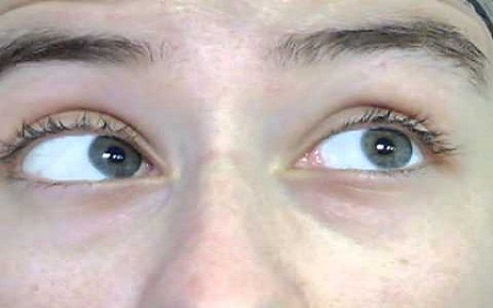 нистагм виды