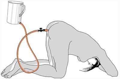 Положение тела при клизмировании