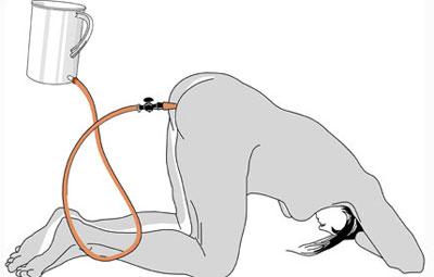 Поза при проведении улизмы