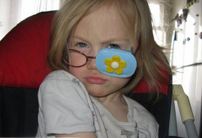 очки для лечения косоглазия