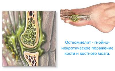 Проявление остеомиелита