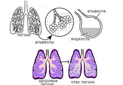 Отек легких