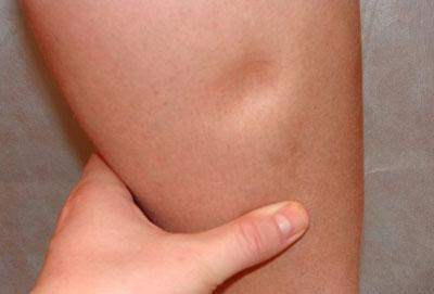 Определение отечности