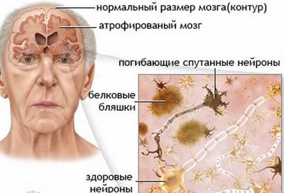 Отмирание клеток головного мозга