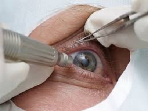 отслоение и виды