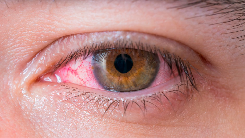 виды кератита