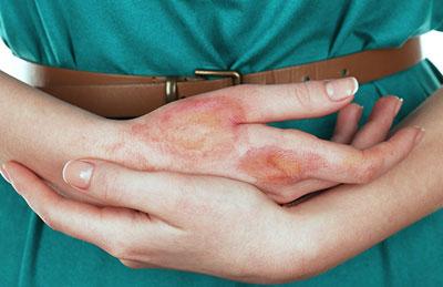 Ожог на руке