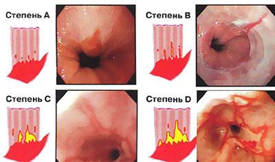 Степени ожога желудка