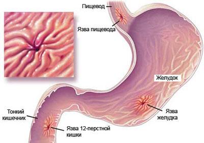 Язвенная болезнь