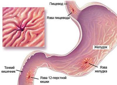 Язвенная болезнь