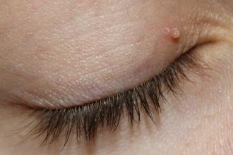 папилломы на веках