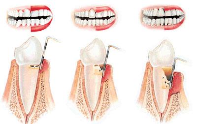 Степени пародонтита