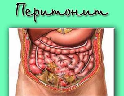 Проявление перитонита