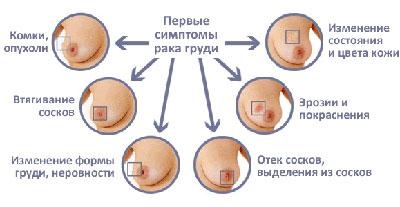 Симптомы рака груди