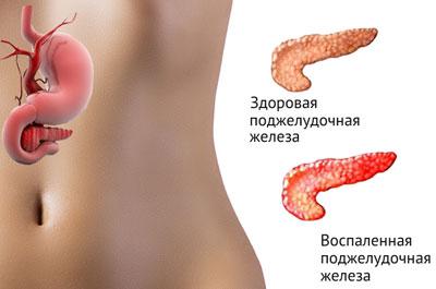 Воспаление поджелудочной железы