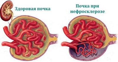 Почки при нефросклерозе