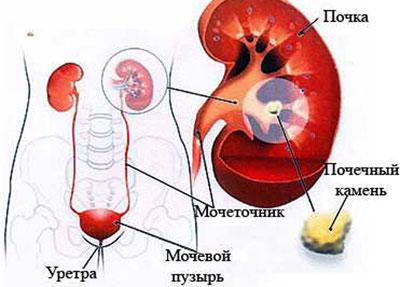 Камни в почке