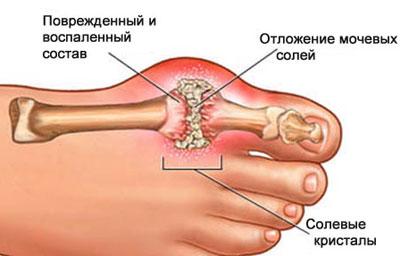 Проявление подагры
