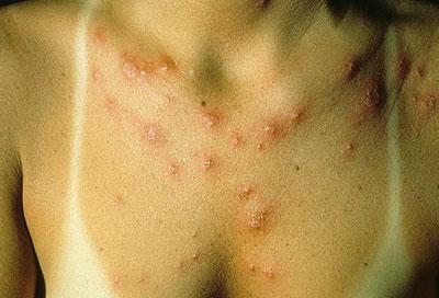 Кожа при дерматозе