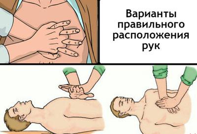 Непрямой массаж сердца