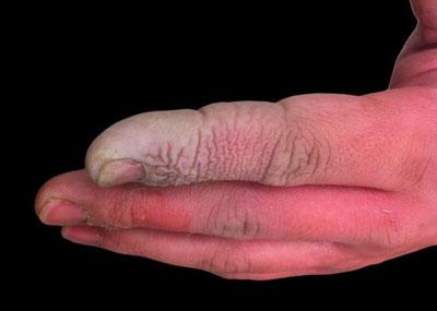 Посинение кожи