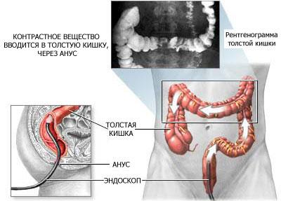 Процедура ирригоскопии