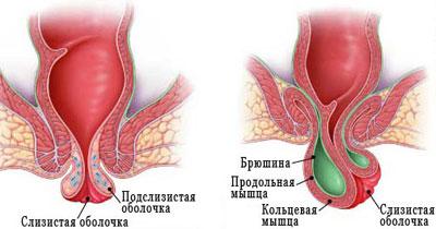 Выпадение прямой кишки