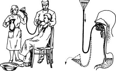 Промывание желудка через зонд