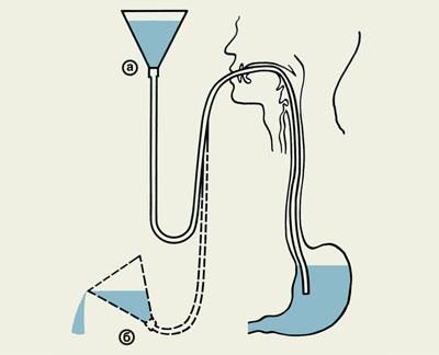 Техника промывания желудка