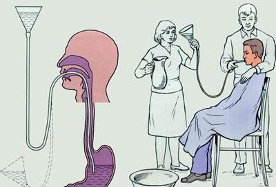 Промывание желудка